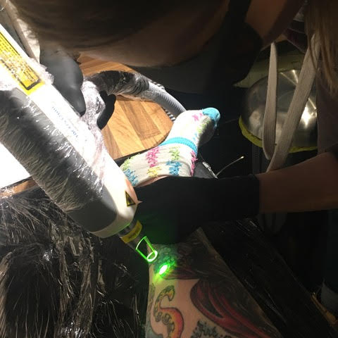 Laser tattoo removal at Folklore Tattoo Studio
